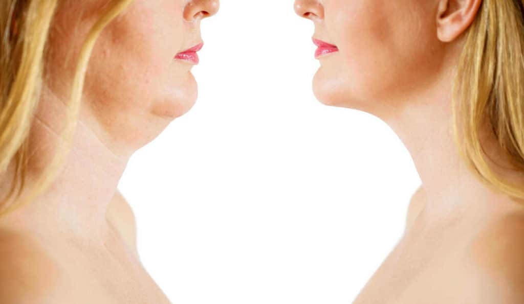 Double Chin treatment Temple Mills before and after results