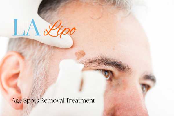 What Are the Most Effective Treatments for Age Spots Temple Mills?