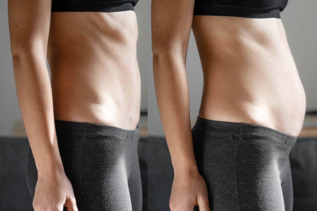 How long does diastasis recti take to improve Temple Mills?