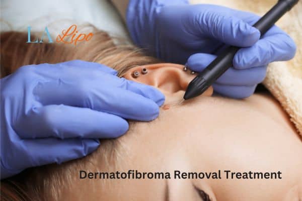 Dermatofibroma Removal Treatment Temple Mills