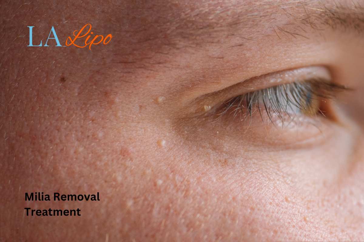 Cryopen Milia Removal: Is It the Easiest and Safest Option Temple Mills?