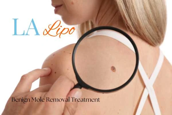Why getting moles removed Temple Mills can boost your confidence!