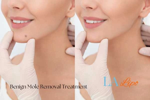 Woman's before and after results of being moles removal treatment Temple Mills