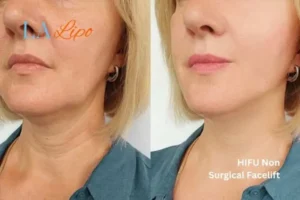 hi-fu for wrinkles Temple Mills before and after results