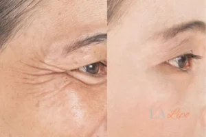 Before and after results of woman - HI-fu wrinkles reduction treatment Temple Mills