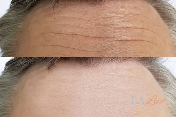 results of HIFU Temple Mills on mans forehead to help reduce lines and wrinkles