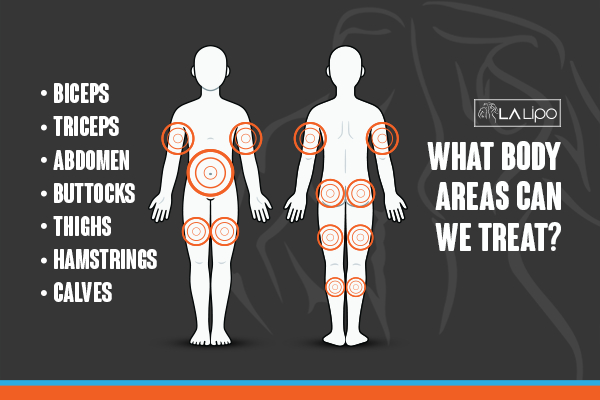 Graphic to show areas you can have LA-EMS Body Sculpting Temple Mills treatment.