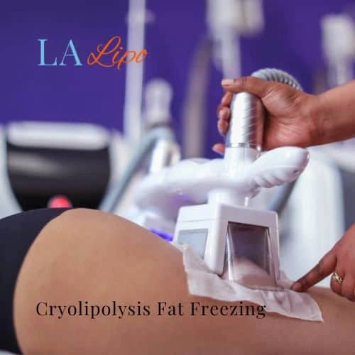 fat freezing - Cryolipolysis Temple Mills