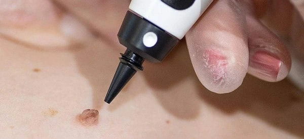 skin tag removal using cryopen Temple Mills