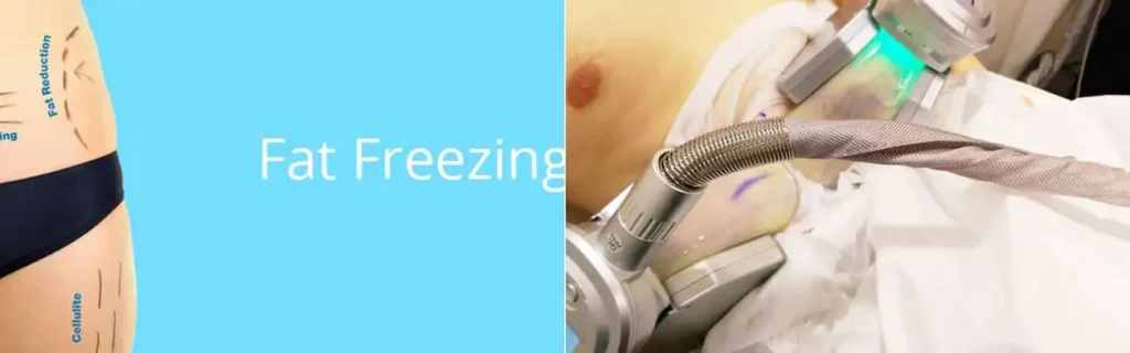 Fat freezing Temple Mills on multiple areas of the body