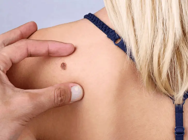 woman having mole removal Temple Mills consultation before treatment.
