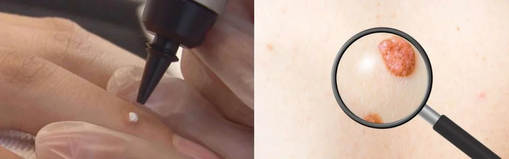 Person getting moles removed with cryopen Temple Mills