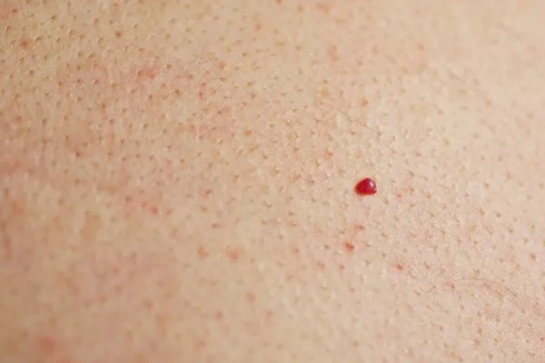 close up of a cherry angioma Temple Mills