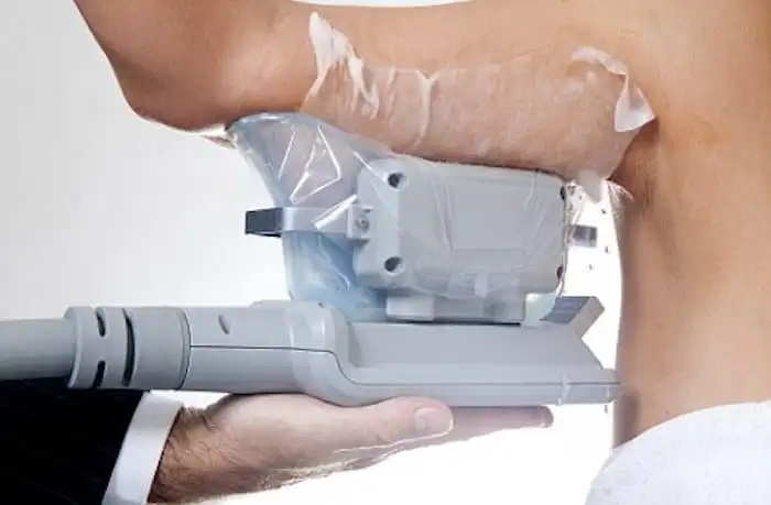 Picture of fat freezing Temple Mills on the upper arms.