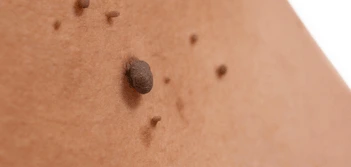 image of a skin tag Temple Mills