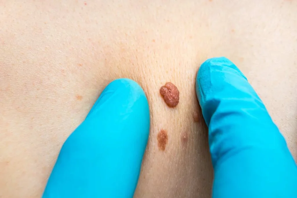 Consultant examining a skin tag Temple Mills