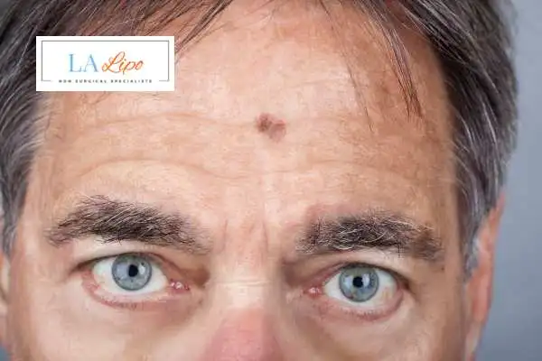 Solar Lentigo Removal Temple Mills image of man with mark on his forehead