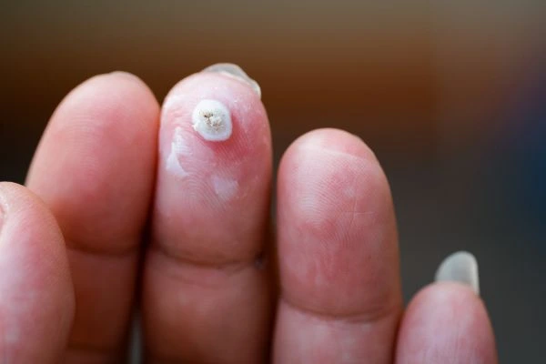 wart on person finger - cryotherapy to treat from LA LIPO Temple Mills
