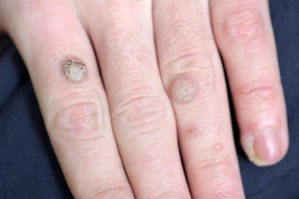 photo of warts on person hand - see wart removal Temple Mills from LA LIPO