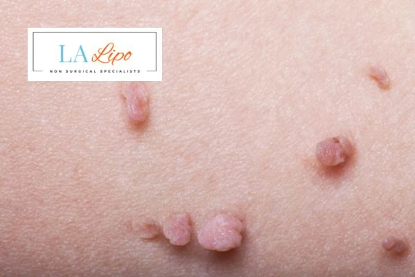 Does cryopen skin tag removal Temple Mills hurt? Find out now call our team today!