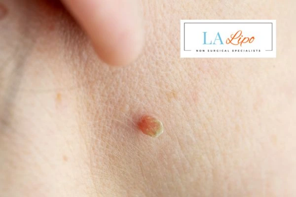 Book skin tag removal Temple Mills today speak to our team now!