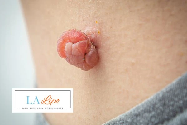 Interested in skin tag removal Temple Mills? Concerned about the pain? Find out more today!