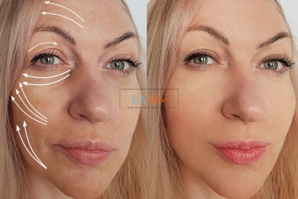 Morpheus 8 results Temple Mills face lift.