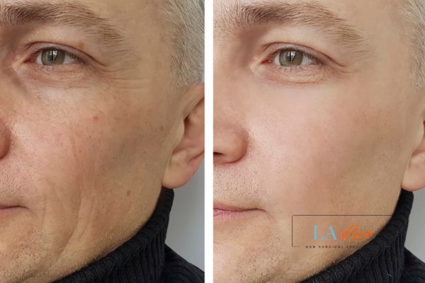 See the amazing results of Morpheus8 Treatment Temple Mills!