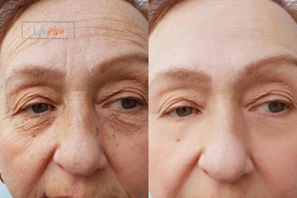 The powerful benefits of Morpheus8 Treatment Temple Mills - Call Our team today!