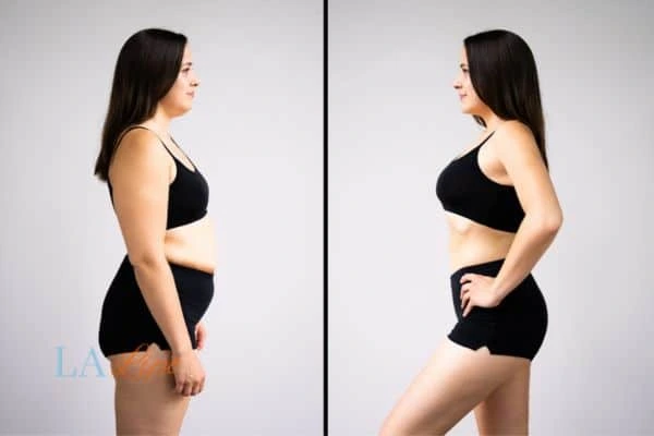 Picture of womans before and after using LA-EMS body sculpting to improve her core strength Temple Mills