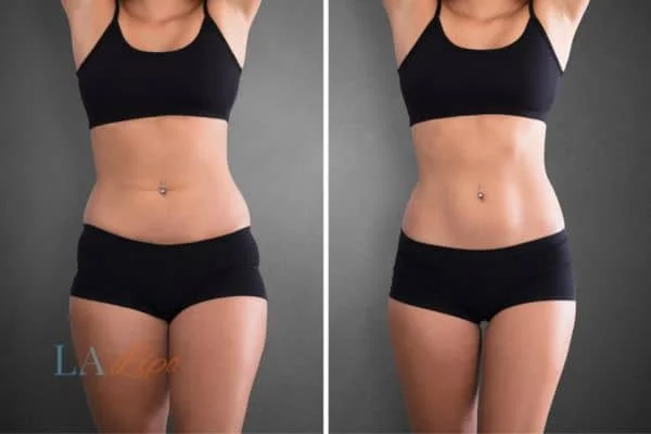before and after results of non-surgical treatment to help a woman's body image and mental health Temple Mills