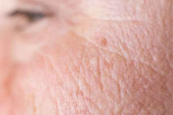 close up picture of a woman's face showing an age spot Temple Mills