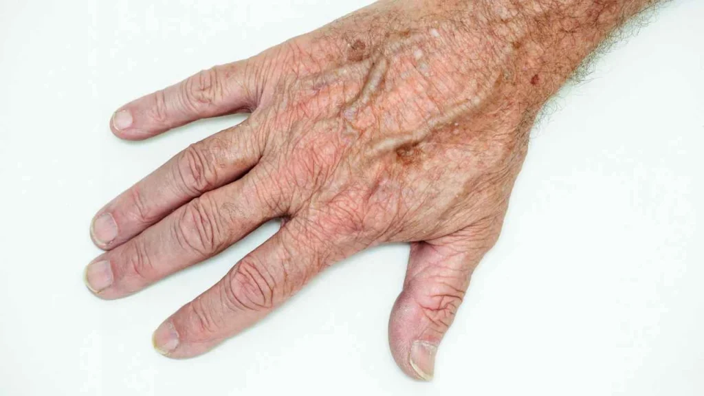 Male hand showing age spot Temple Mills