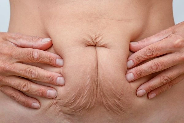 Should I Combine Diastasis Recti Treatment with Body Contouring for Better Results Temple Mills?
